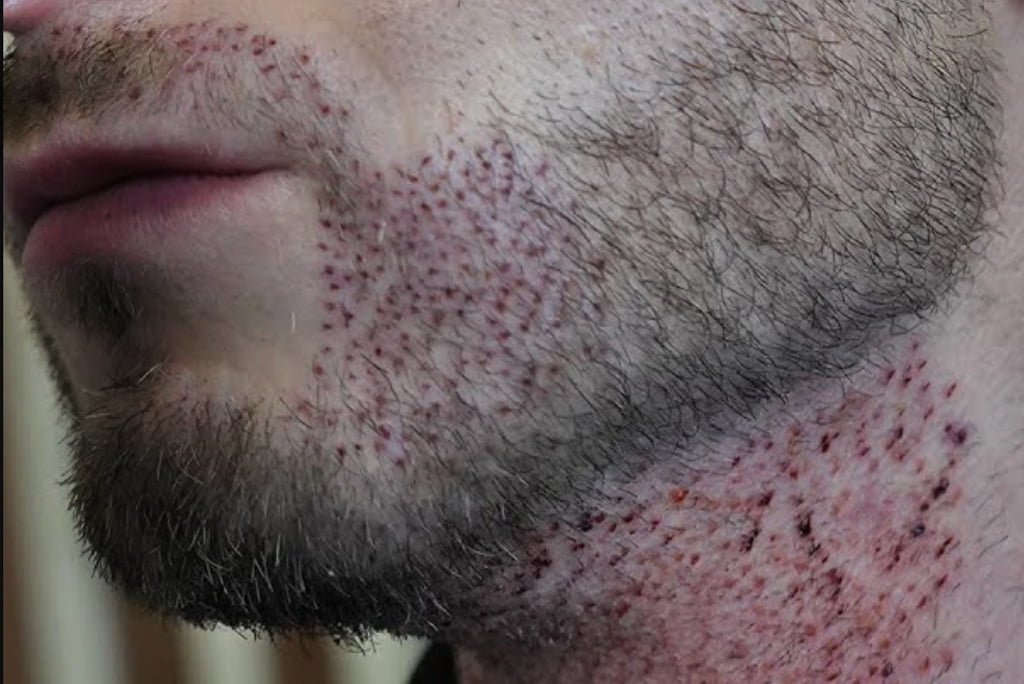 beard transplantation