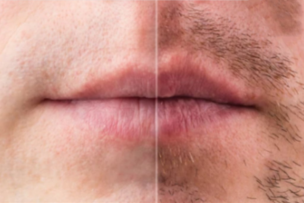 moustache transplant
