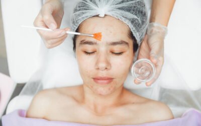 Chemical Peels vs Microneedling: Finding the Best Treatment for You