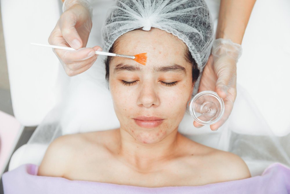 Chemical Peels vs Microneedling: Finding the Best Treatment for You