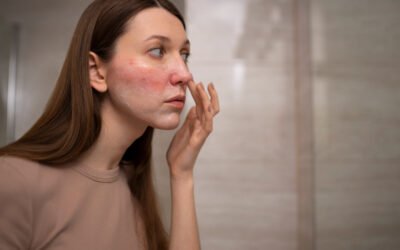 Steroid-Induced Rosacea: The Dangers of Self-Medicating with ‘Fairness’ Creams