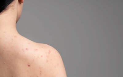 The Science of Body Acne: Why Summer Heat Makes ‘Backne’ Harder to Treat