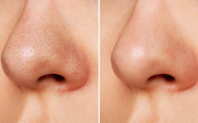 Blackheads vs Whiteheads: Correct Extraction & Care