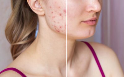 Effective Acne Treatment: Symptoms, Causes, Diagnosis, and Solutions