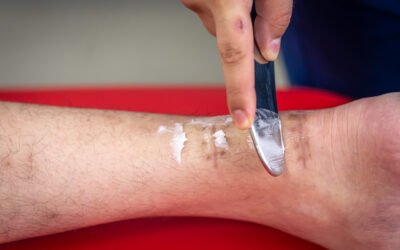 Chronic Wounds Explained: Why Healing Slows Down in Diabetes