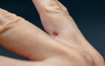 Keratosis Pilaris — Why Those Tiny Bumps Appear on Your Skin