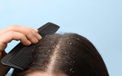 Dandruff vs Seborrheic Dermatitis — How to Identify the Difference
