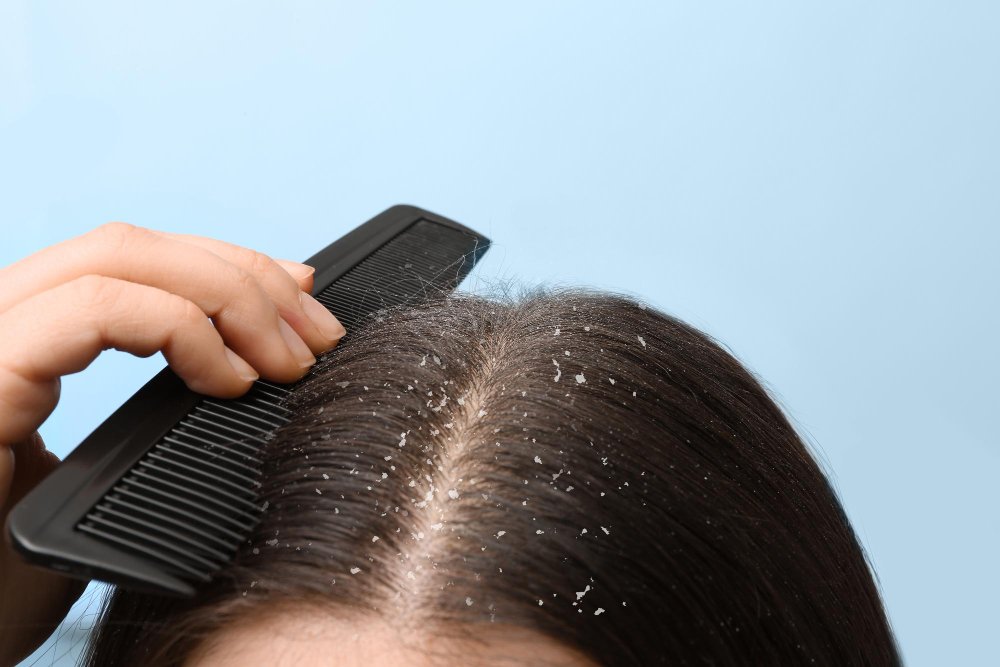 Dandruff vs Seborrheic Dermatitis — How to Identify the Difference