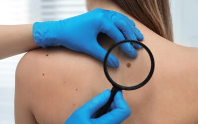 Warts — Why They Appear and How Dermatologists Treat Them