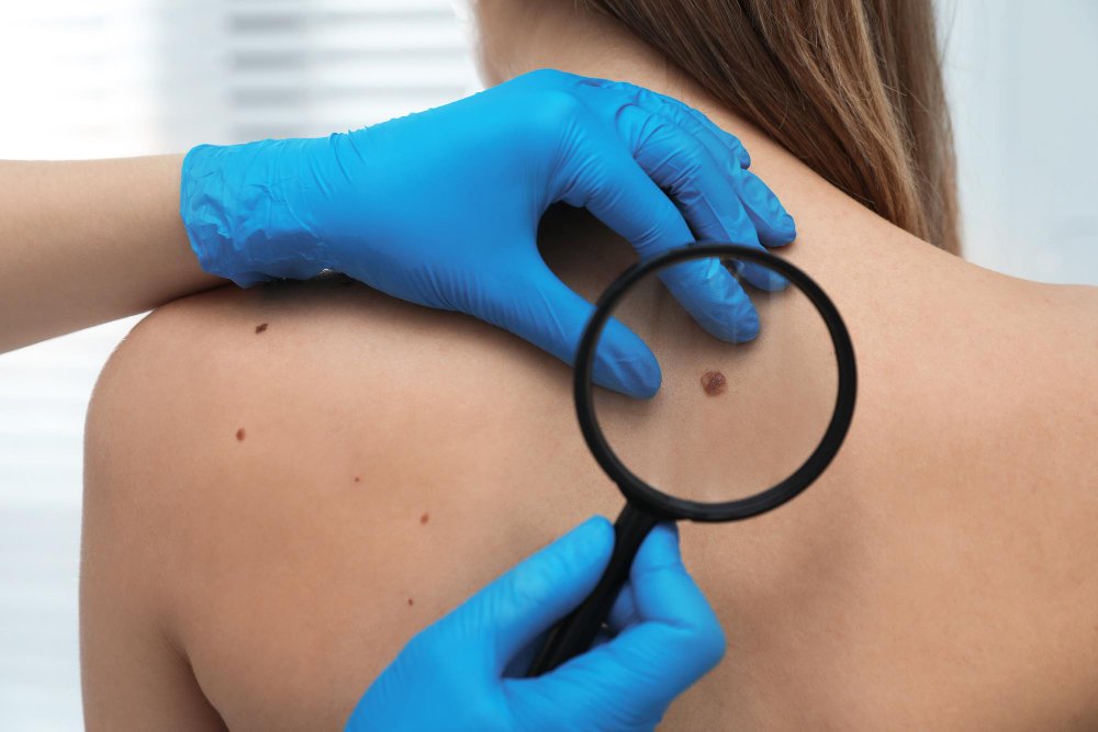 Warts — Why They Appear and How Dermatologists Treat Them