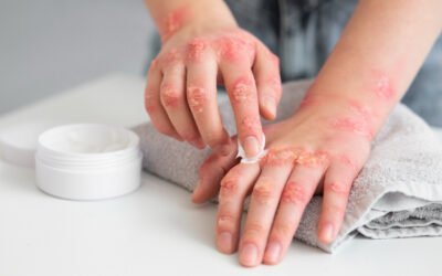 Contact Dermatitis: What Could Be Irritating Your Skin?