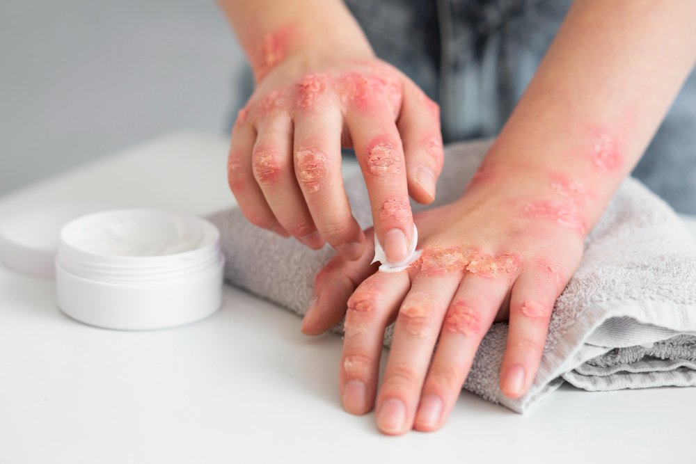 Contact Dermatitis: What Could Be Irritating Your Skin?